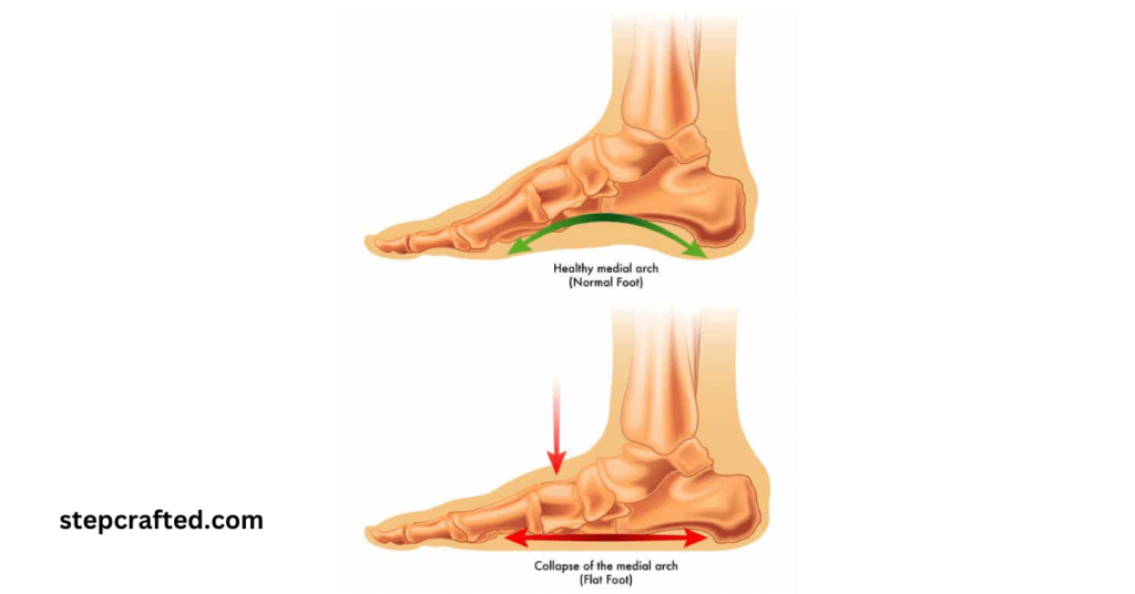 Can You Build Arches in Flat Feet?